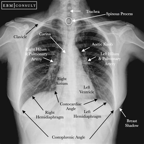 affordable no insurance chest x ray in memphis area
